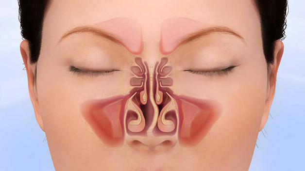 cách chữa viêm xoang mũi mãn tính