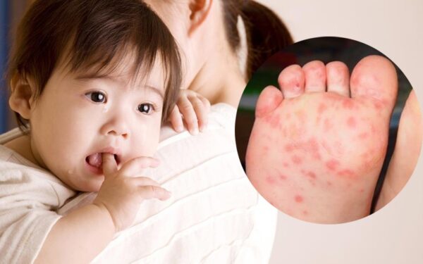 Cách điều trị bệnh tay chân miệng tại nhà cho trẻ em -1