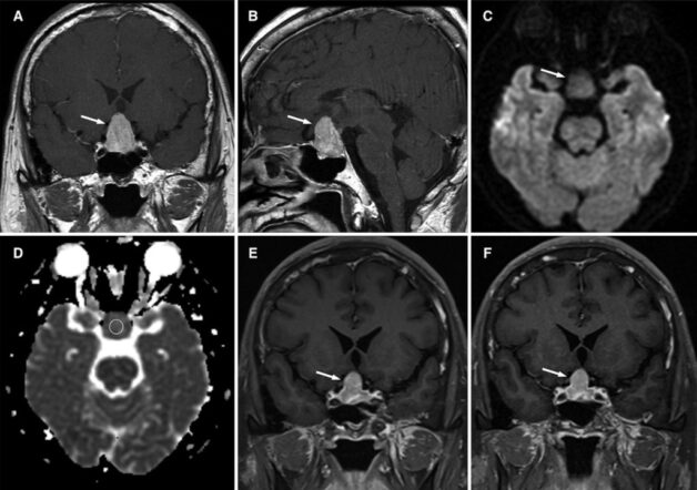 Hình ảnh phim chụp MRI tuyến yên
