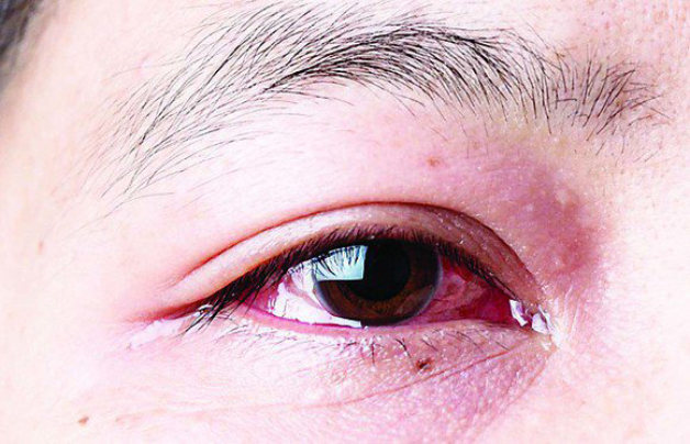 Các triệu chứng đi kèm khi bị đỏ mắt