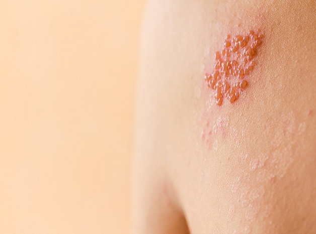 Những dấu hiệu ở làn da cảnh báo các bệnh lây truyền qua đường tình dục