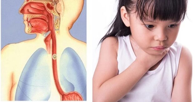 dị vật trong mũi có rơi xuống phổi không