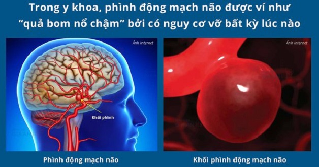 bệnh đột quỵ xuất huyết não