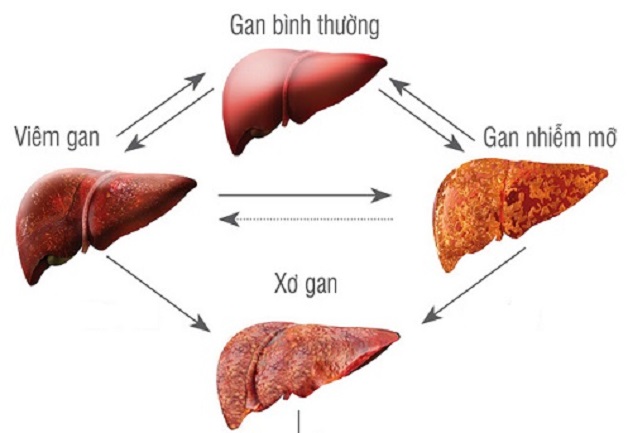 Gan nhiễm mỡ không được điều trị kịp thời có thể gây ra biến chứng nguy hiểm như xơ gan