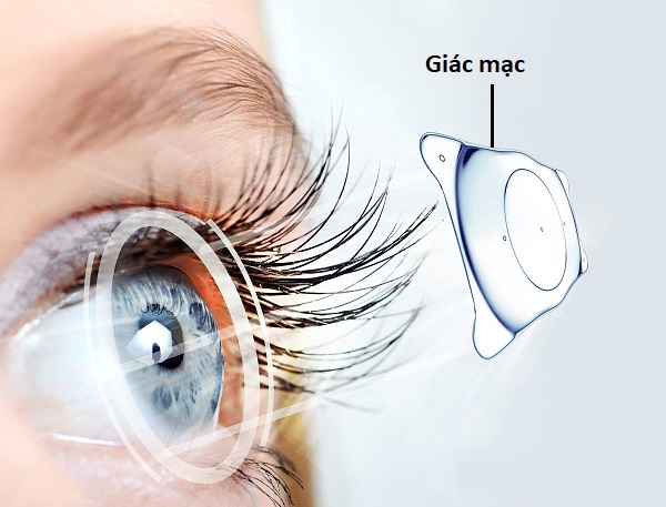 Giác mạc nhân tạo là gì?