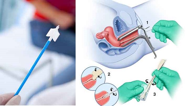 Pap smear 