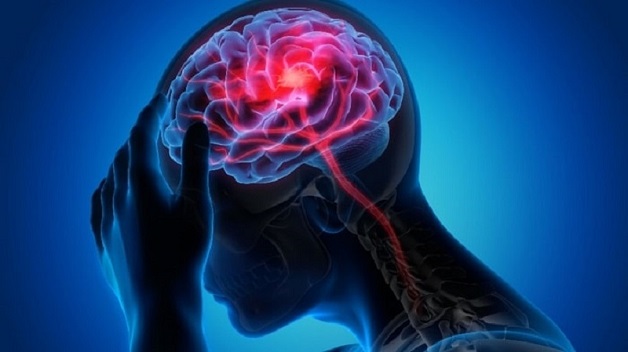 Hậu quả của tai biến chảy máu não do dị dạng mạch não