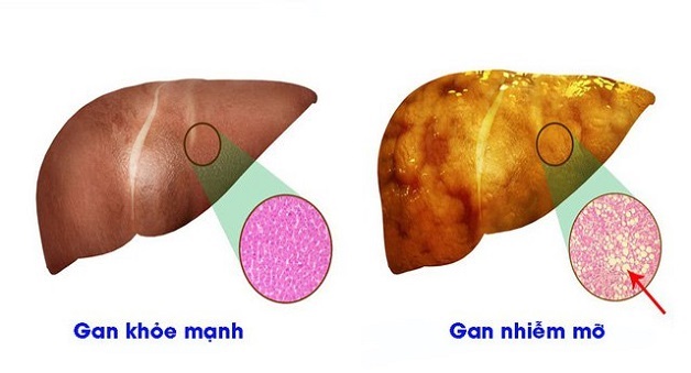 tác hại của bệnh gan nhiễm mỡ