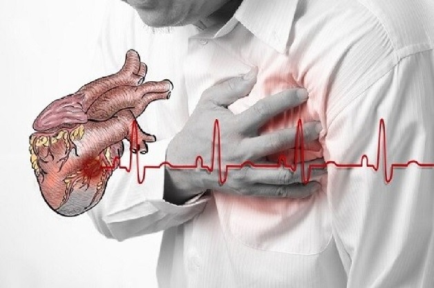 Nhồi máu cơ tim là tình trạng tắc nghẽn mạch vành, gây thiếu máu cơ tim đột ngột