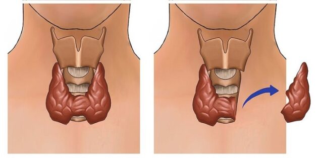 Tìm hiểu về phương pháp phẫu thuật điều trị ung thư tuyến giáp