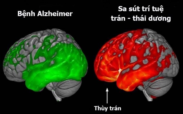 sa sút trí tuệ tâm thần