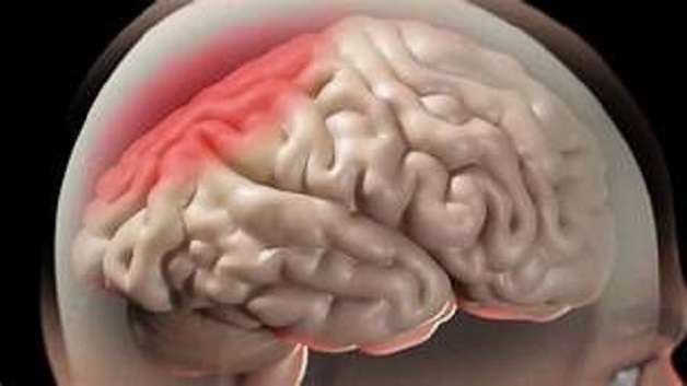 Tăng áp lực nội sọ - Biến chứng của đột quỵ