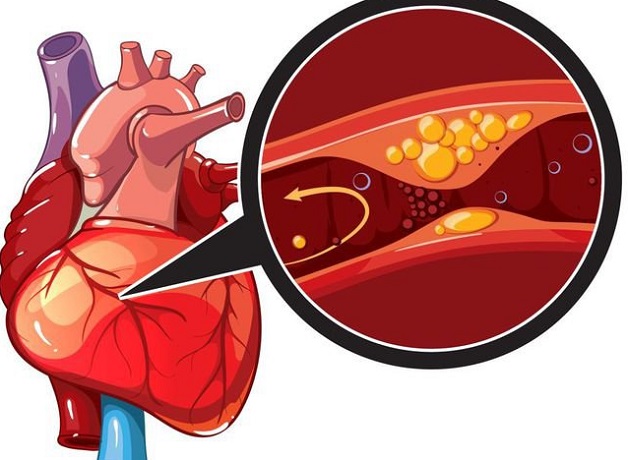 Cơ tim bị thiếu máu nuôi dưỡng nếu mạch máu nuôi dưỡng cơ tim bị tắc nghẽn.