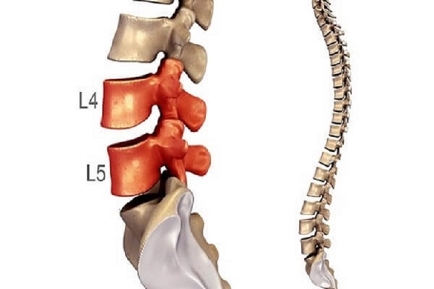 Thoát vị đĩa đệm L4 L5 có thể gây ra nhiều vấn đề nguy hiểm