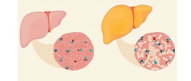 gan nhiễm mỡ ở người trẻ không do rượu