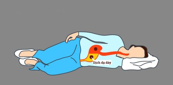 Nằm nghiêng bên trái hạn chế trào ngược dạ dày