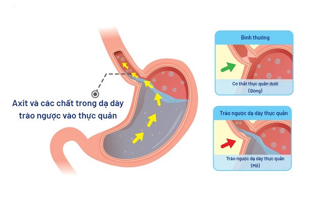 lý giải Trào ngược dạ dày có gây đau đầu không