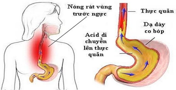 nguyên nhân Trào ngược dạ dày lên mũi