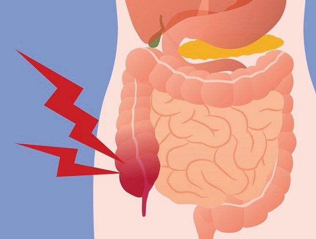 Viêm ruột gây ra triệu chứng của viêm ruột thừa