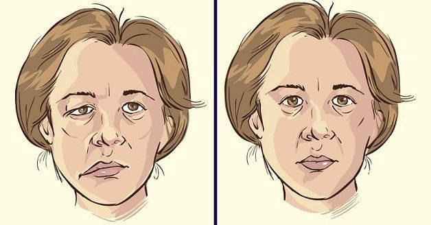 Triệu chứng lâm sàng của tai biến mạch máu não cần phải được phát hiện kịp thời
