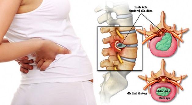 Thoát vị đĩa đệm xảy ra khi đĩa đệm trong xương sống bị thoát ra khỏi vị trí bình thường