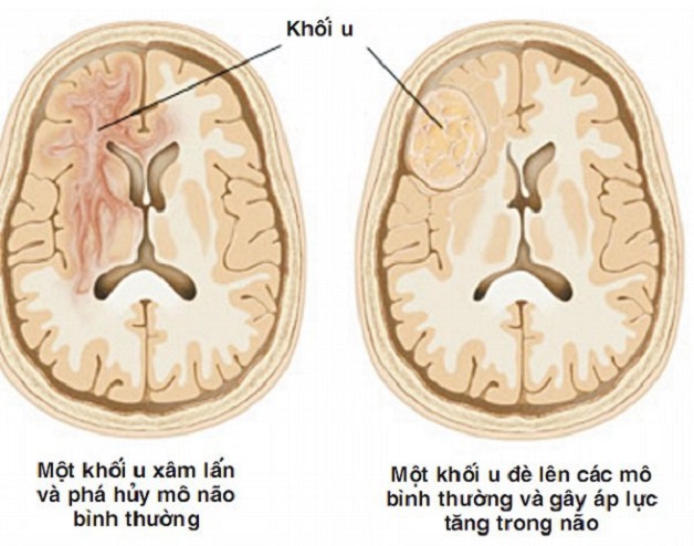 Biến chứng động kinh do u não gây ra