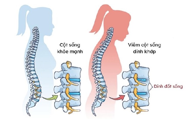 Viêm dính khớp cột sống là tình trạng viêm nhiễm mạn tính, gây viêm đau tại cột sống và lưng dưới