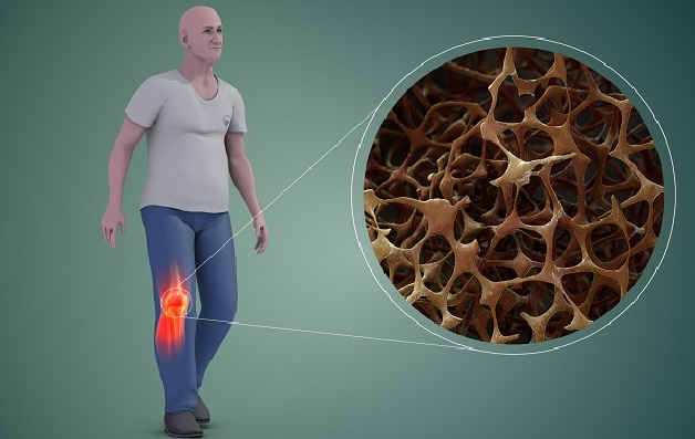 Viêm khớp dạng thấp biến chứng loãng xương nếu không được điều trị kịp thời