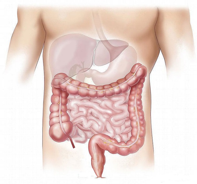 Viêm ruột non là bệnh lý phổ biến ở hệ tiêu hóa