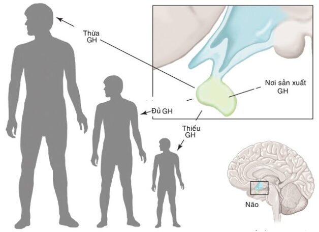 Tăng tiết hormone tăng trưởng gây phát triển quá nhanh ở trẻ em