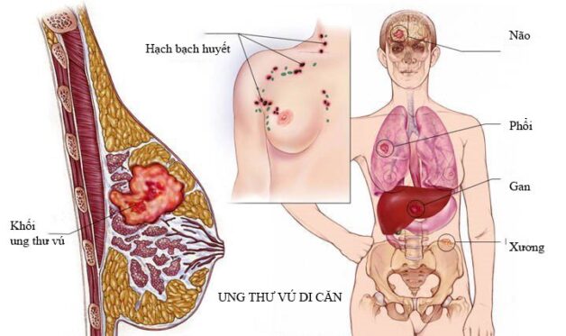Phụ nữ từng ung thư vú cần tầm soát ung thư vú định kỳ