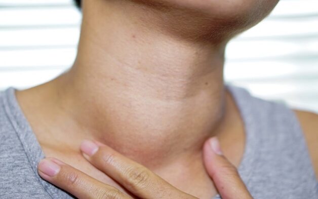 Bướu tuyến giáp gây mất thẩm mỹ cho người bệnh