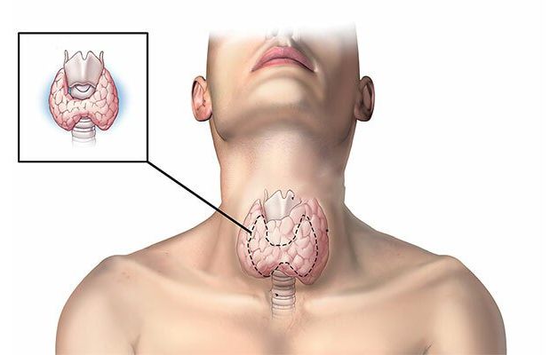 Tuyến giáp lớn gây mất thẩm mỹ