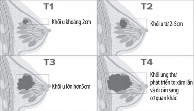 Khối u vú khi còn lành tính và khi phát tiển sang ung thư vú