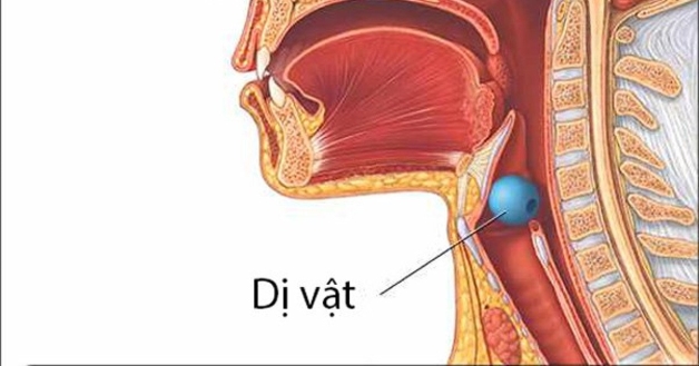 hóc dị vật ở đường thở