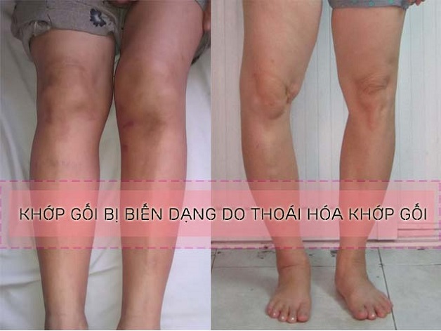 thoái hóa khớp là gì? có bị biến dạng khớp không