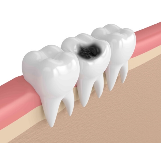 cách trị sâu răng đen