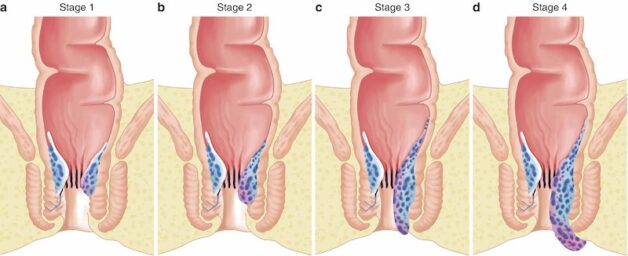 Hình ảnh mô phỏng các cấp độ của bệnh trĩ