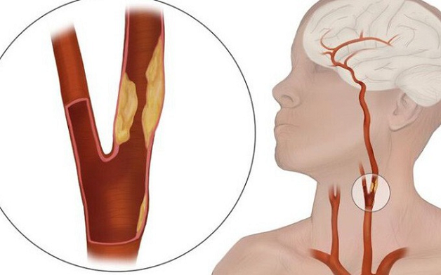 cập nhật điều trị nhồi máu não