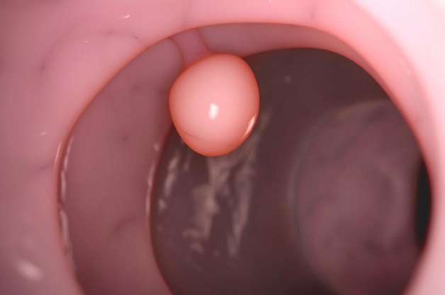 Nhiều người thường lo lắng khi có polyp trong đại tràng