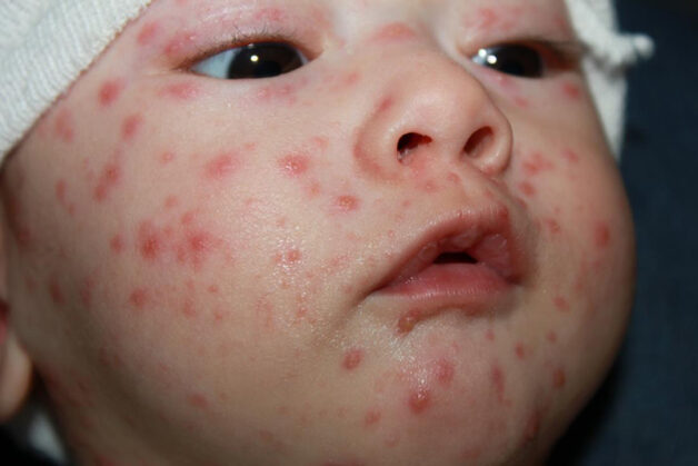 Mụn nước mọc trên nền các ban đỏ đã xuất hiện từ giai đoạn khởi phát.