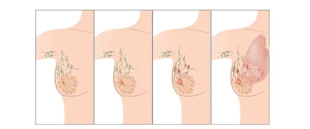 Tìm hiểu về phương pháp phẫu thuật ung thư vú