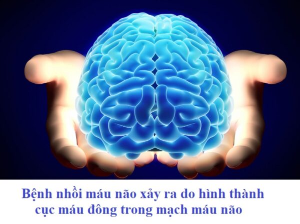 dự phòng sa sút trí tuệ