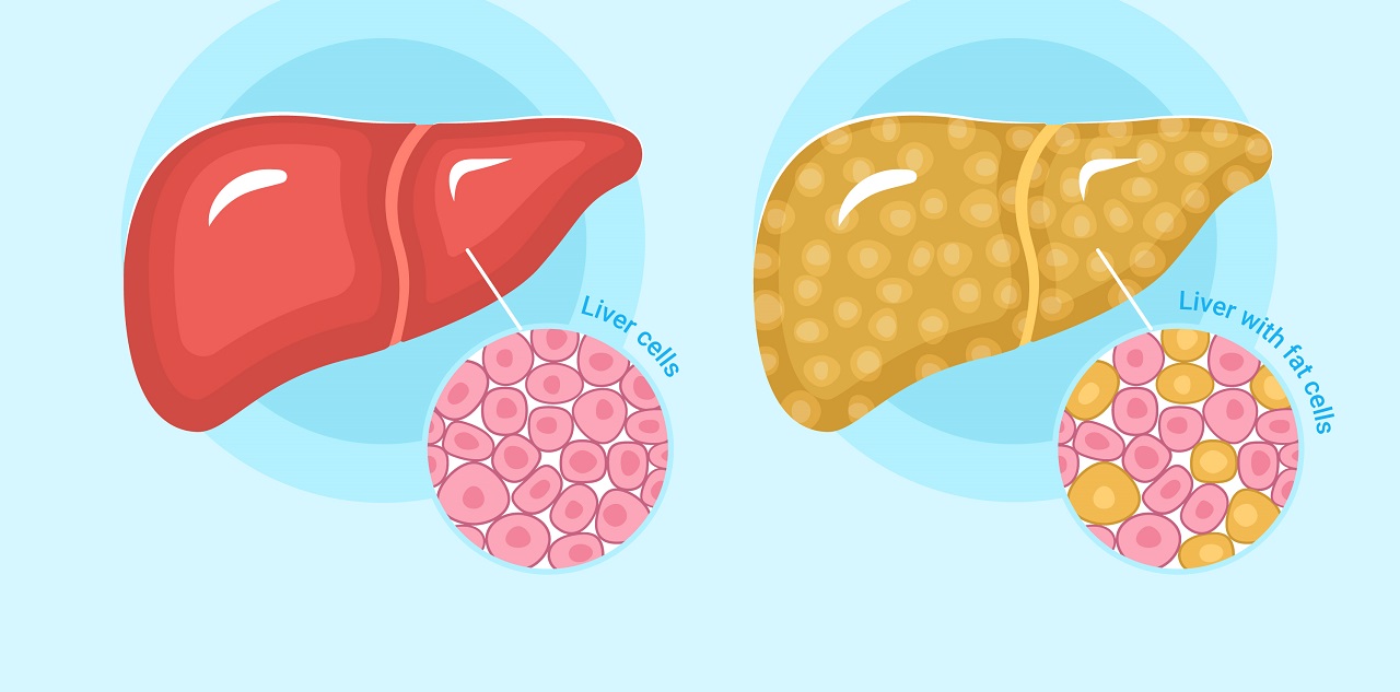 Gan nhiễm mỡ c&oacute; t&aacute;c hại g&igrave; v&agrave; c&aacute;ch kiểm so&aacute;t