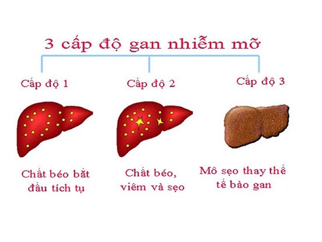 Mức độ nguy hiểm của bệnh gan nhiễm mỡ phụ thuộc vào giai đoạn bệnh.