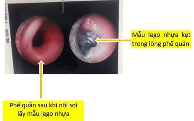 Gắp dị vật trong phế quản