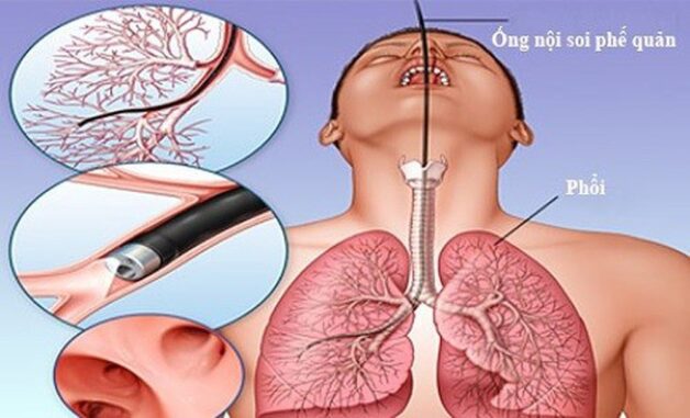 Gắp dị vật trong phế quản