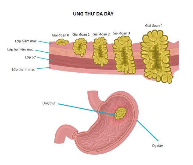 Điều trị bệnh ung thư dạ dày theo giai đoạn