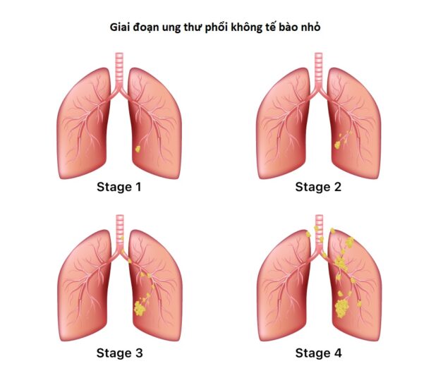 Ung thư phổi có những giai đoạn nào và tiên lượng điều trị ung thư phổi