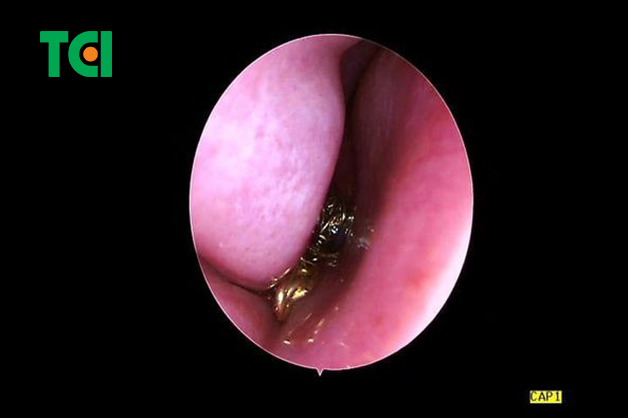 lấy dị vật trong lỗ mũi